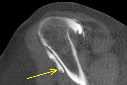 Figure 5 for case Supraspinatus and biceps tendon tears ( RID1953 )( RID1944 )